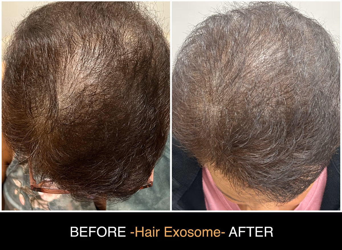 Ultrasound Scalp with DE|RIVE Exosomes