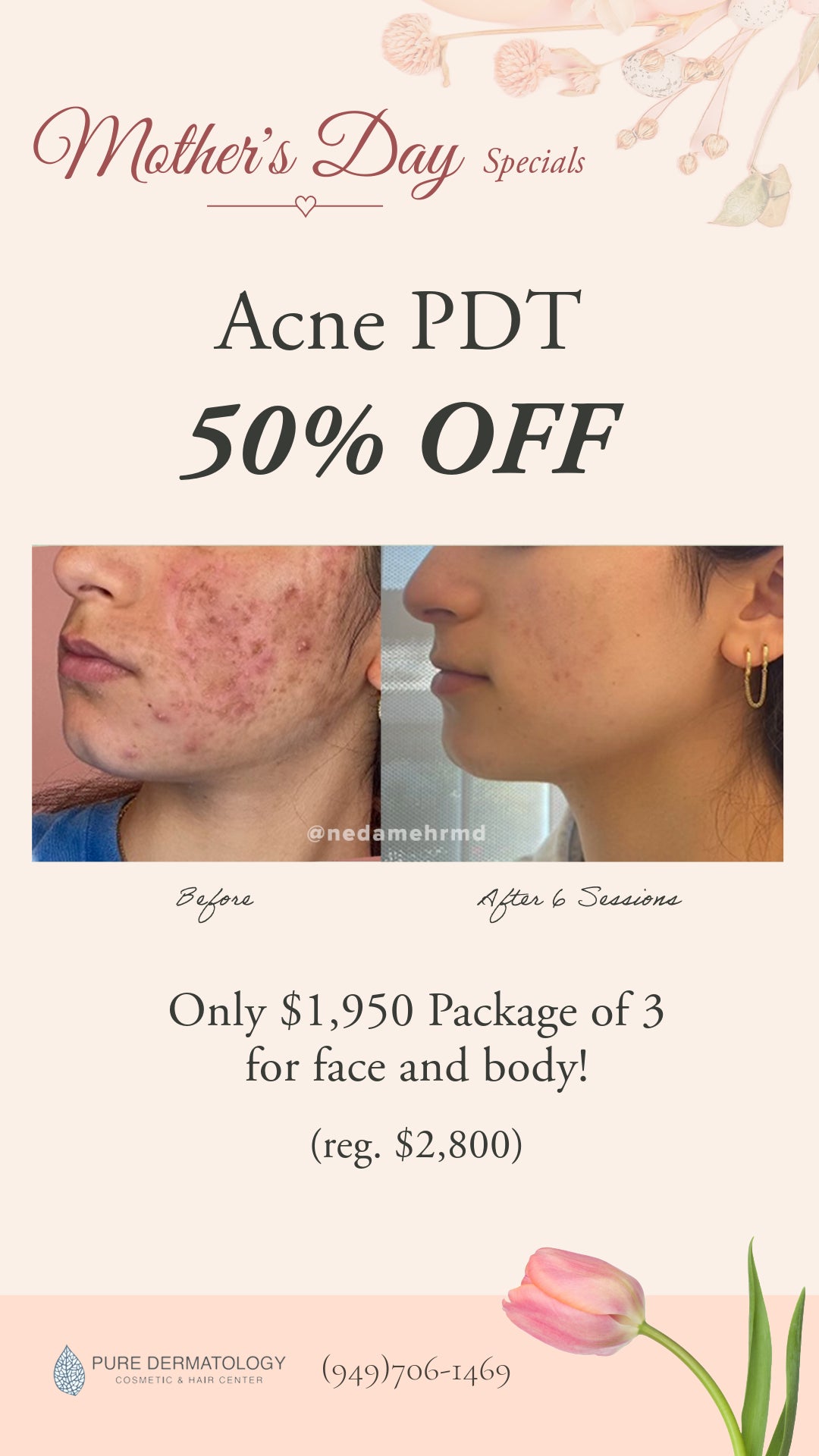 Acne PDT - 50% OFF
