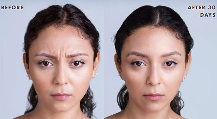 Boo-Tox Special: Botox &amp; Xeomin (Oct 12-16 Only)