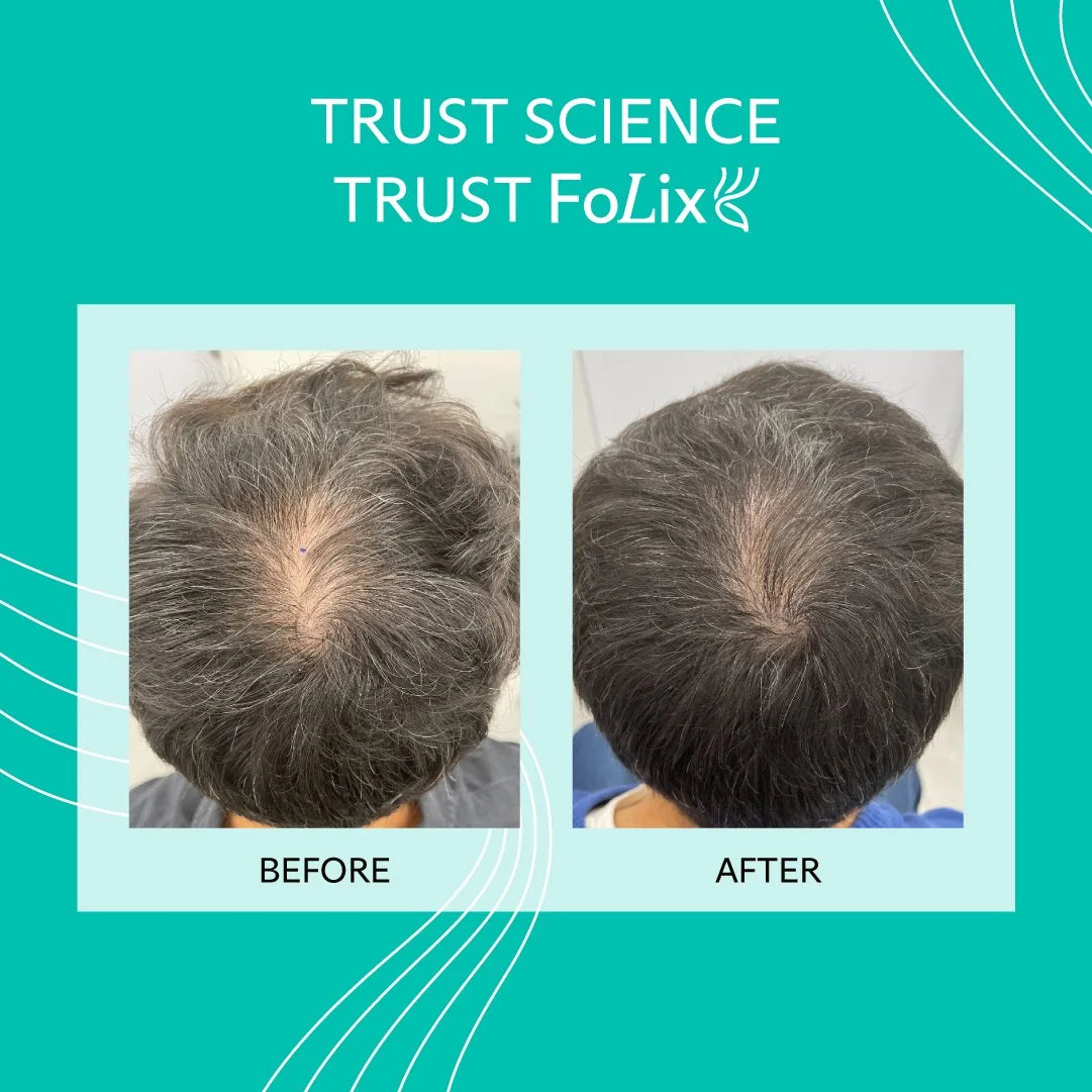 FoLix Laser Hair Regrowth