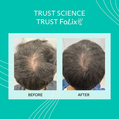 FoLix Laser Hair Regrowth
