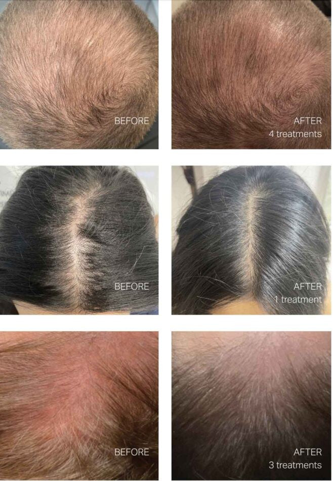 Keravive Scalp