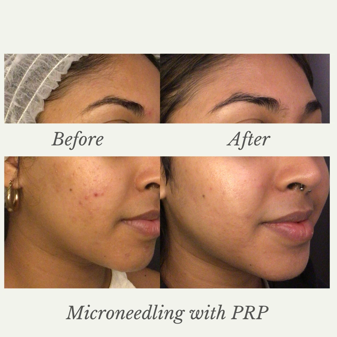 SkinPen with PRP