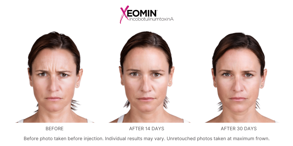 Xeomin + Filler Bundle